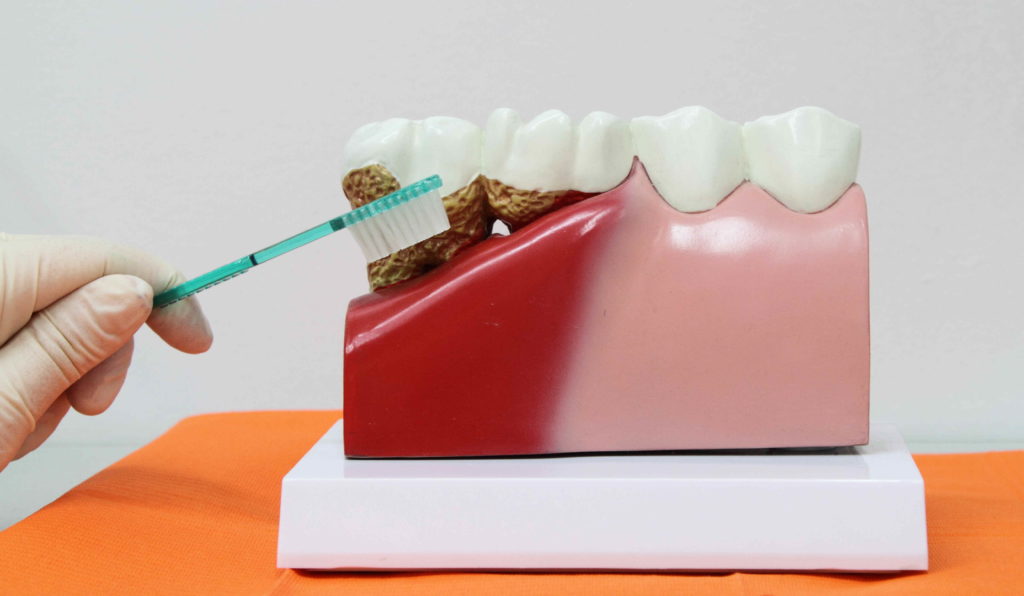 gingivitis or periodontitis