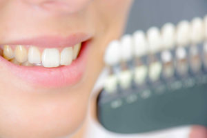 coloration des dents et blanchiment dentaire