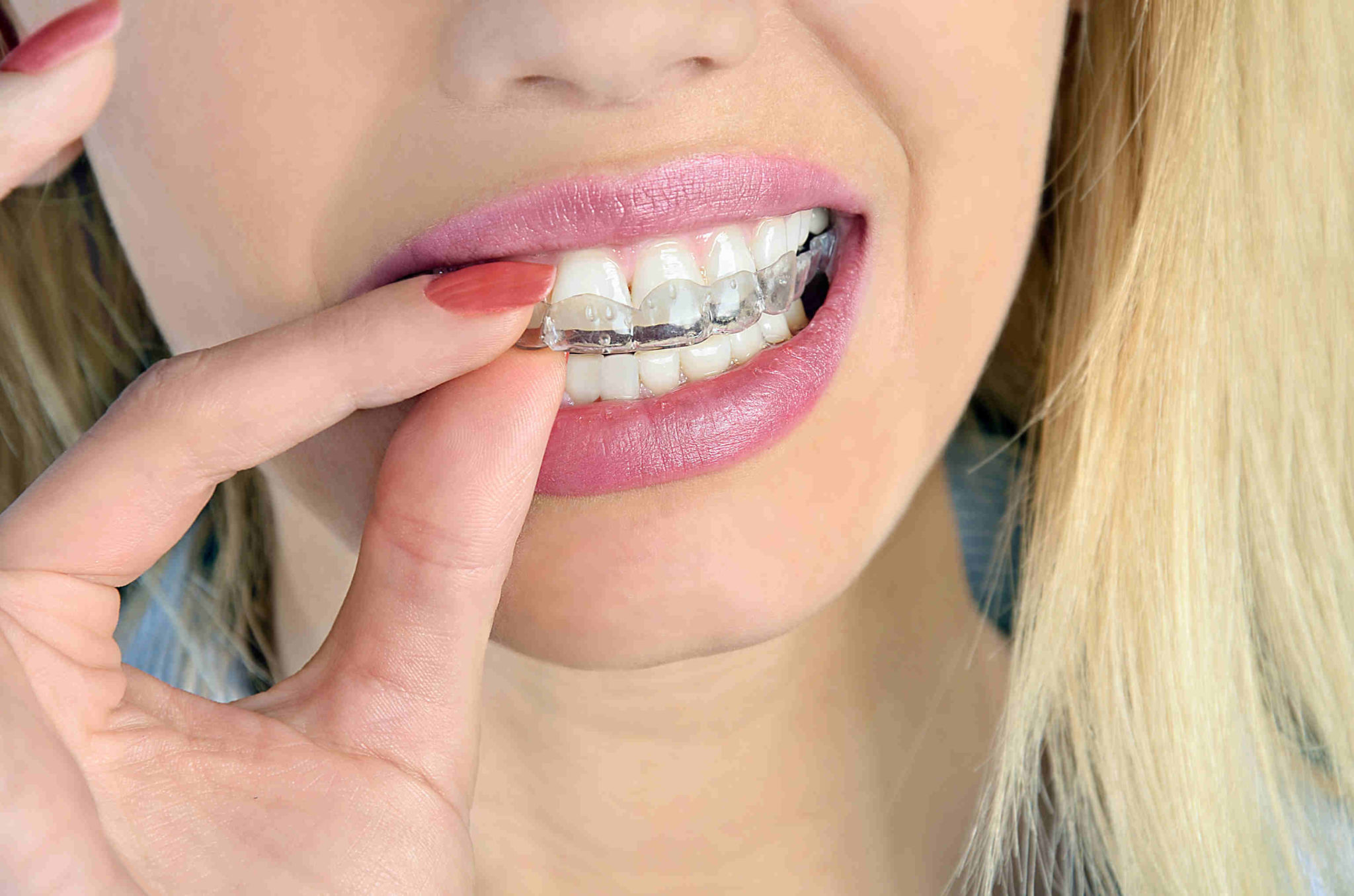Gouttière dentaire contre le grincement des dents - Outspot