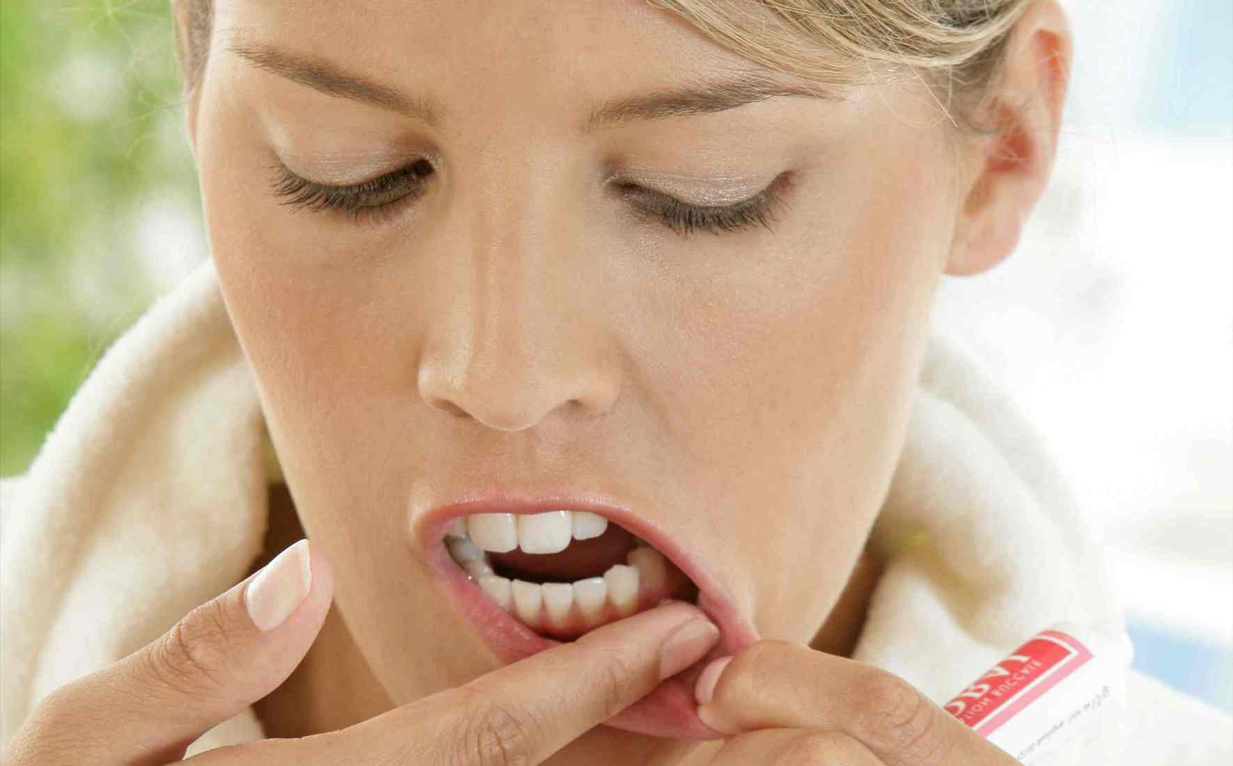 Aphtes dans la bouche : les dentistes répondent à vos questions