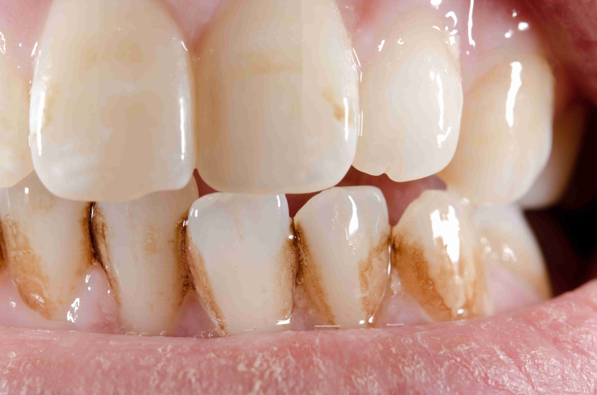Tartre dentaire : symptômes, cause, comment l'enlever ?