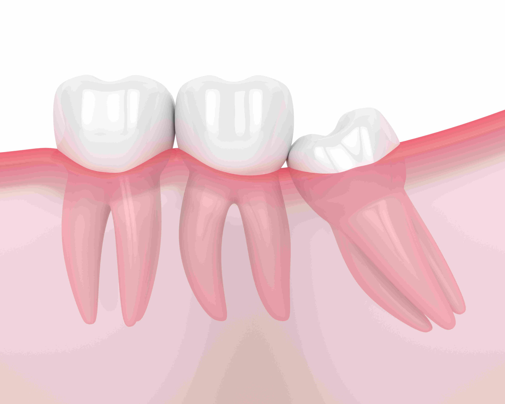 Dents de sagesse : apaiser la douleur post-opération - Helvident