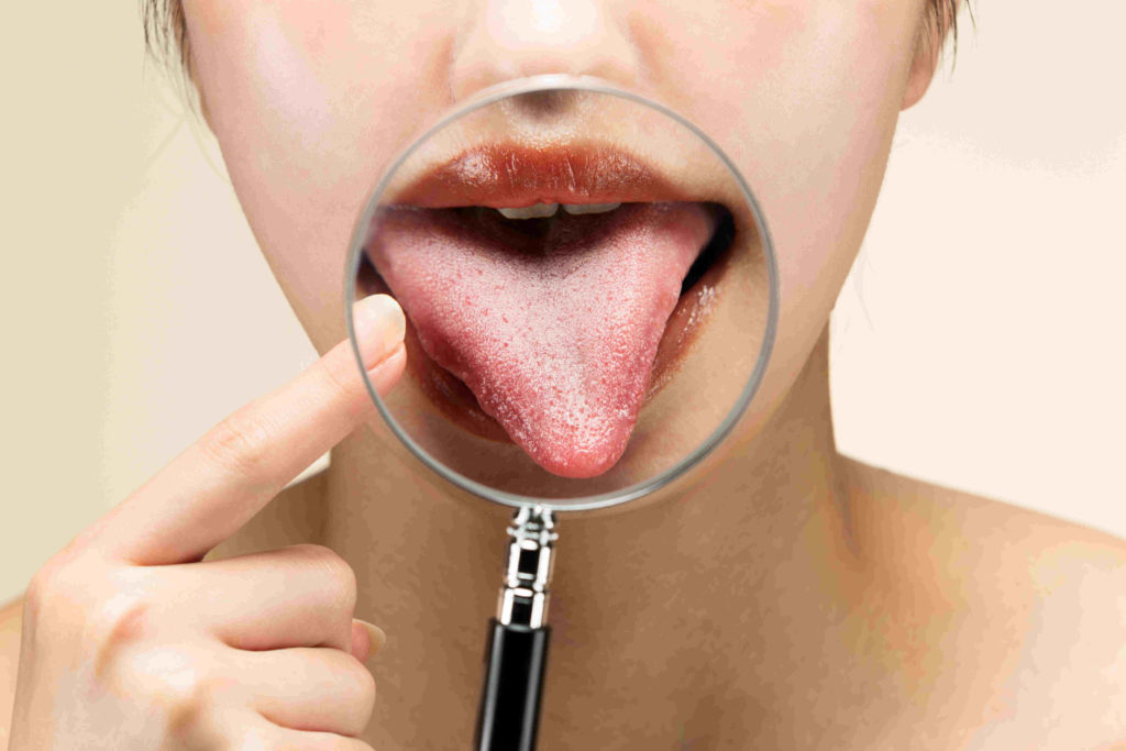 tongue aphthae