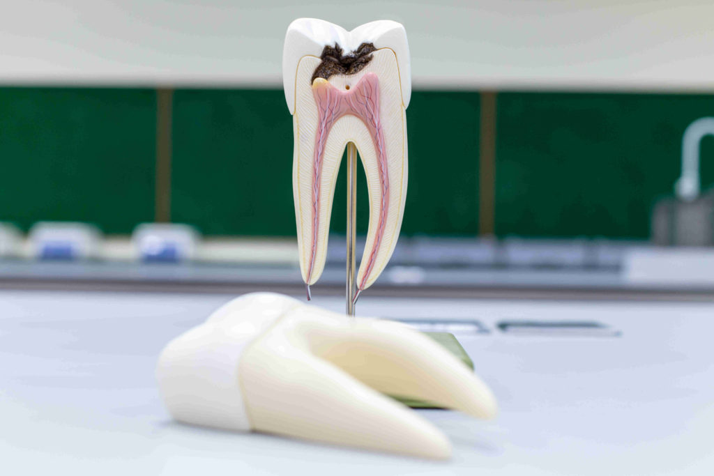dental devitalization