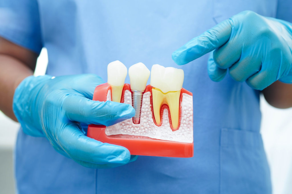 implants en zircone
